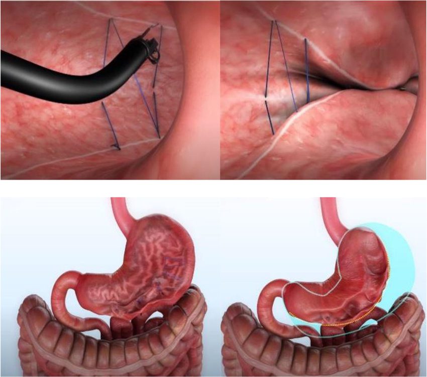 What is OverStitch endoscopic sleeve gastroplasty