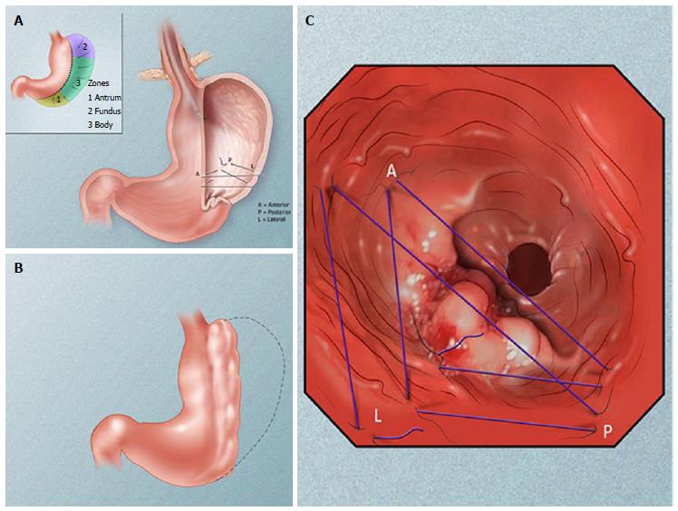 Is the Endoscopic Sleeve Gastroplasty permanent