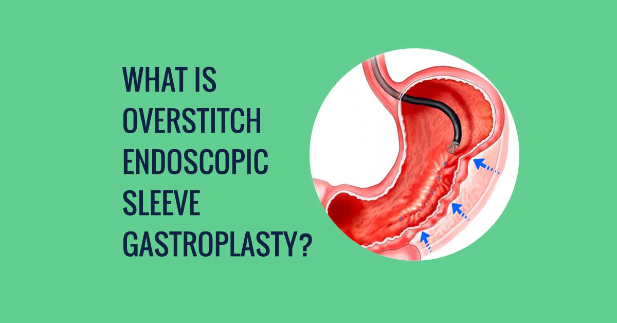 What is overstitch endoscopic sleeve gastroplasty