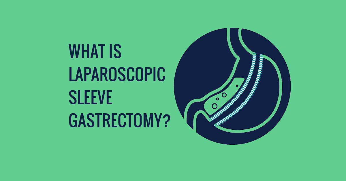 What is laparoscopic sleeve gastrectomy