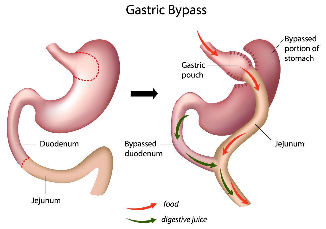gastric bypass surgery healthyweightaustralia