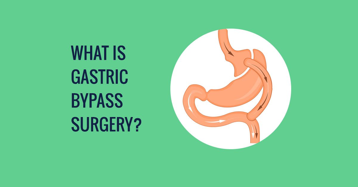 What is gastric bypass surgery