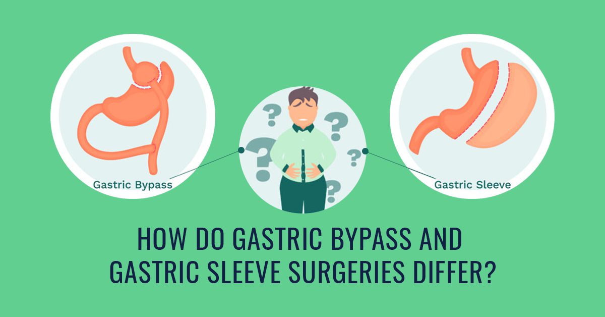 Gastric Bypass and Gastric Sleeve Surgeries Differ